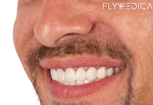 Sekrety Hollywood Smile: Licówki i wybielanie zębów z ekspertami Flymedica w Turcji